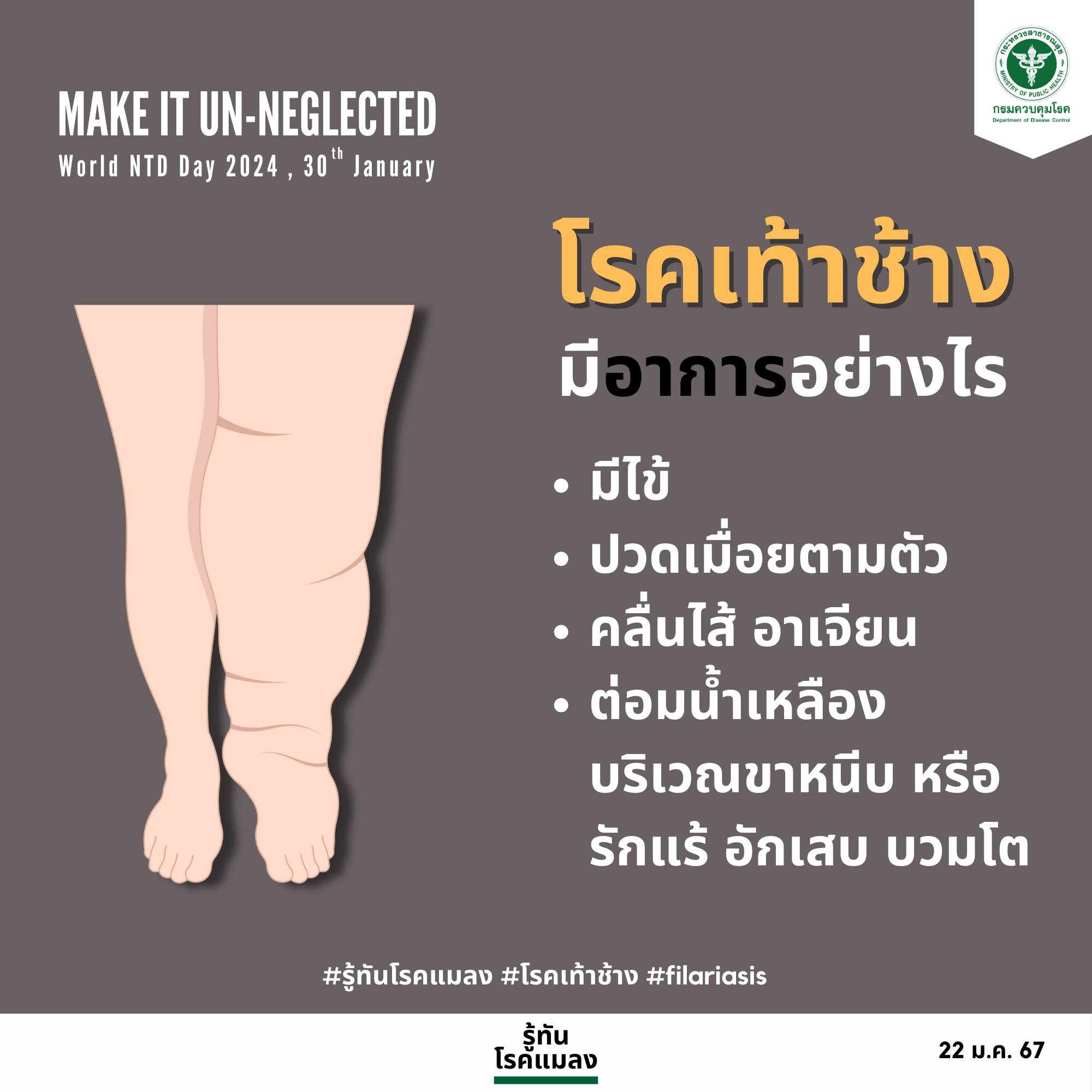 โรคเท้าช้าง